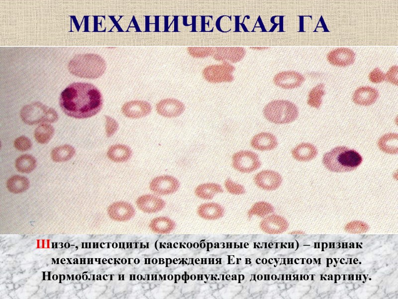 МЕХАНИЧЕСКАЯ  ГА Шизо-, шистоциты (каскообразные клетки) – признак механического повреждения Er в сосудистом